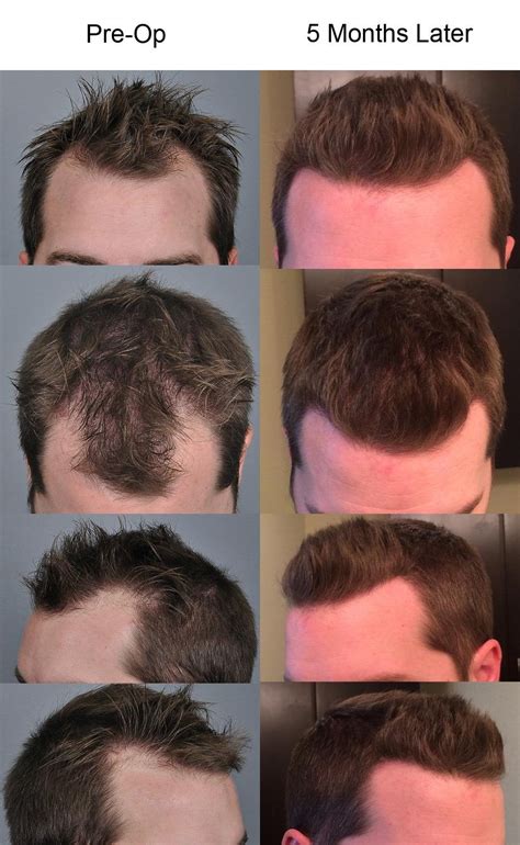 hair transplant reddit|hair transplant month by progress.